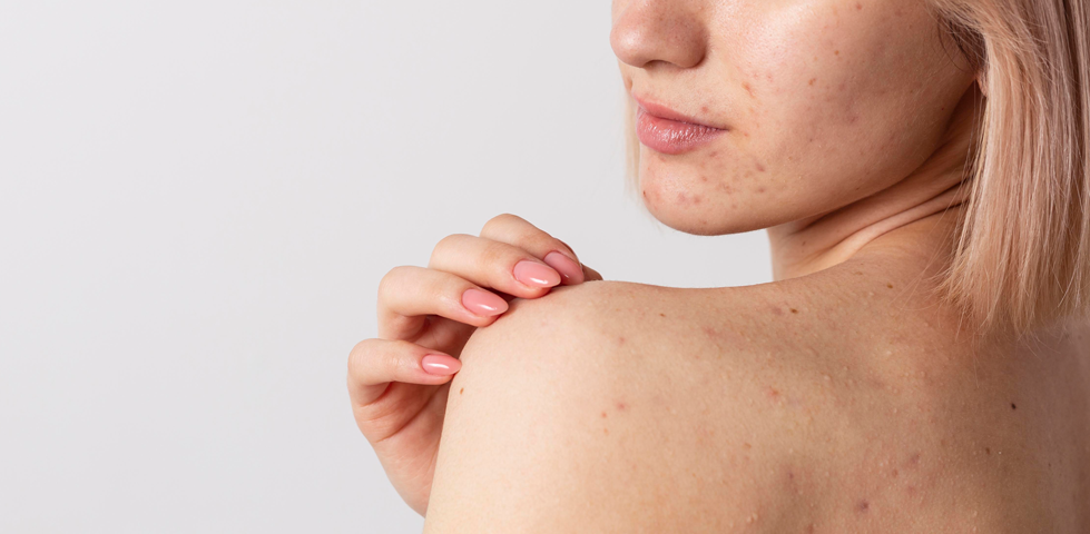 Pimples on the back - causes and treatment