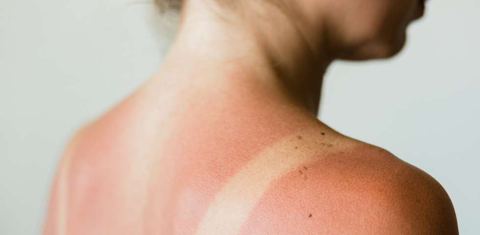 Treating sunburn – effective tips for relief