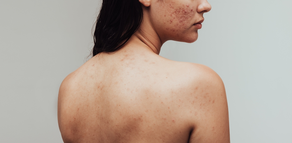 Acne tardiva: consigli contro l'acne negli adulti